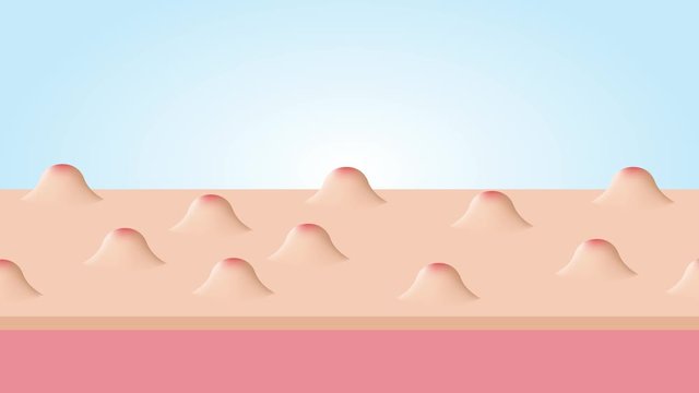 Acne and Pimples, stages of development, graphic animation