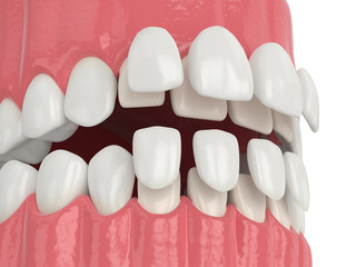 3d render of jaw with upper and lower veneers