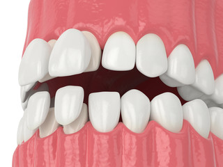 3d render of jaw with upper and lower veneers