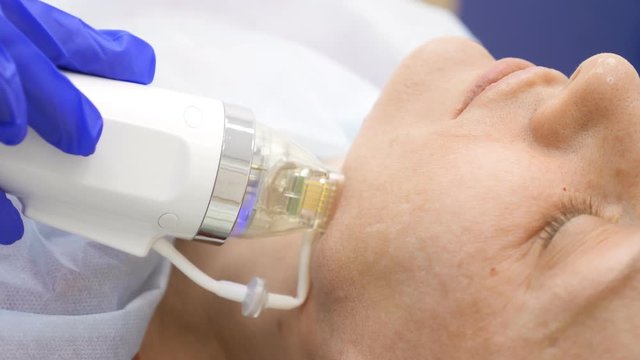 close-up. microneedle RF lifting procedure. Hardware cosmetology. Beautician conducts a facial rejuvenation procedure for a bald woman.