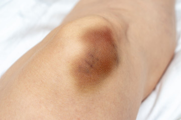 A big bruise, hematoma extravasation on female leg, knee injury