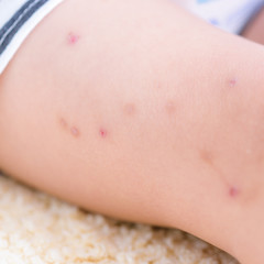 Kid legs with spot scar mosquito bites sore after scratch