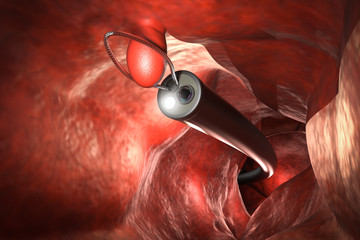 endoscope remove colonic polyp