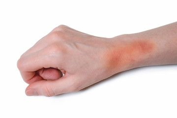 Female hand with big bruise on white background. Ointment treatment.