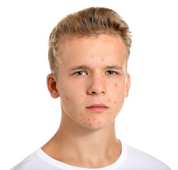 Obraz premium Teenage boy with acne problem on white background