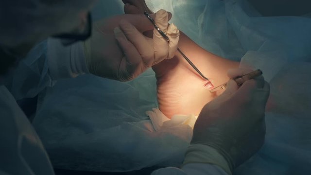 Surgeon making surgery of removal ankle hygroma in hospital in operating room, hands closeup. Doctor examines incision area, upping skin by clamp. Operation surgical treatment of hygroma on leg.