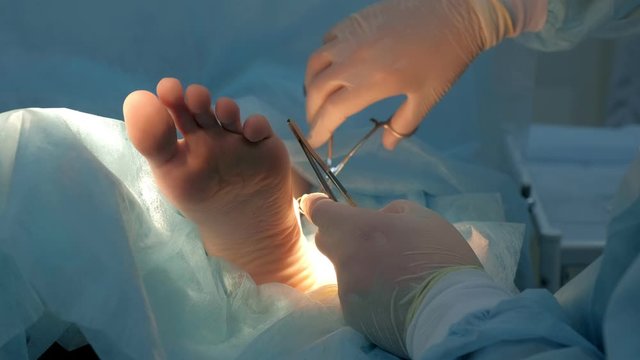 Surgeon sews wound on leg after surgery using self-absorbable threads, hands closeup. Doctor sutures ankle during surgery with neat stitches after removing hygroma. One day surgery concept.