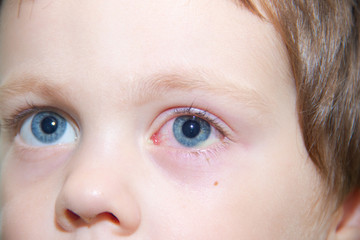 Obraz premium conjunctivitis in the eye of a child. Ophthalmic diseases. Red eye . Vessels burst in the eye.