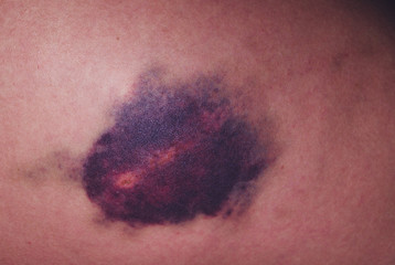 Injury of the knee joint. Big bruise on knee.