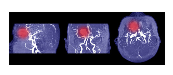 MRA AND MRV OF BRAIN Multiple acute intracranial hemorrhage at bilateral frontal lobes.