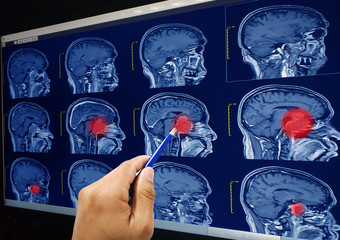 Magnetic resonance imaging (MRI) of the brain, brain tumor, brain abscess on red point , sagittal...