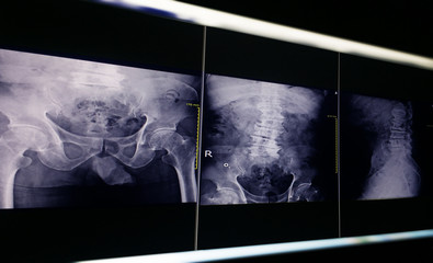 x-ray image pelvic bone and hip joint, degenerative change L4-5 lumbar Scoliosis film x-ray lumbar spine AP, Lateral.