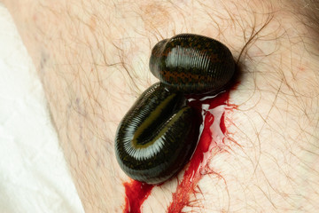 Blutegelbehandlung, Makroaufnahme, medizinische Blutegel