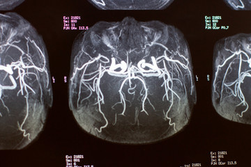 magnetic resonance image MRI scan of human brain 