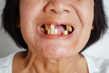 An elderly Asian woman smiled and saw the remaining teeth in the mouth. Due to partial loss...