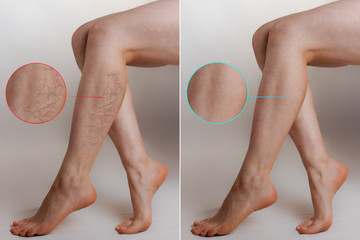 Medicine and health. The concept of female varicose veins. Female legs with vascular stars on the...