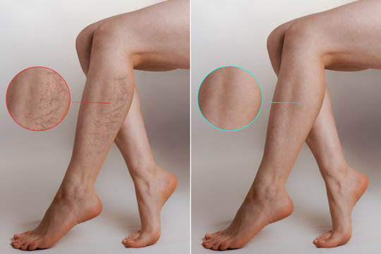 Medicine and health. The concept of female varicose veins. Female legs with vascular stars on the legs, with an enlarged picture. Before and after