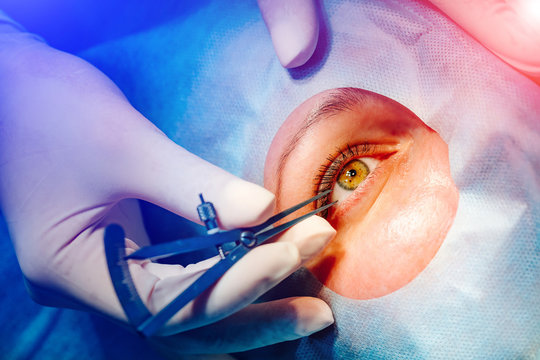 Laser vision correction. A patient and team of surgeons in the operating room during ophthalmic surgery. Eyelid speculum. Patient under sterile cover