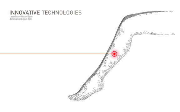 3D woman leg endovenous laser operation concept. Medical surgery veins varicose treatment female foot. Cosmetic hair laser depilation healthy massage salon care vector illustration