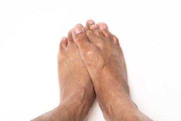 Fototapeta premium Asian man foot brown and dry skin