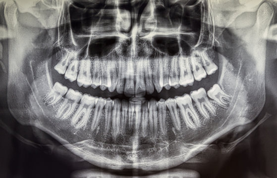 Orthopantomography of an adult patient, dentistry