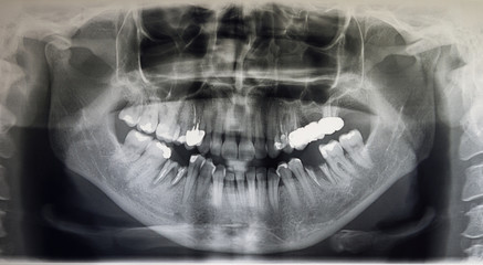 Orthopantomography of an adult patient, dentistry