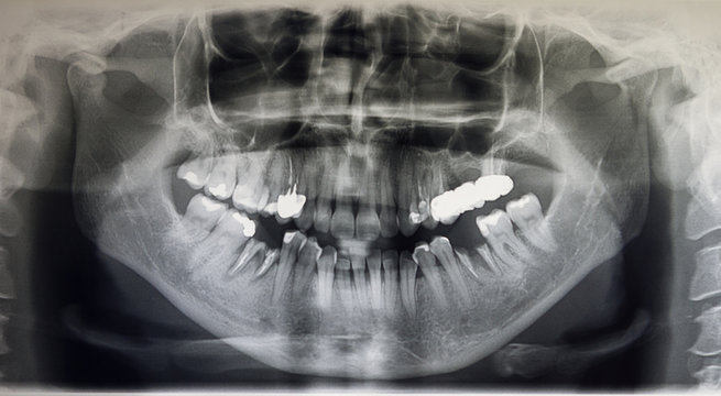Orthopantomography of an adult patient, dentistry