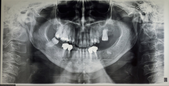 Orthopantomography of an adult patient, dentistry