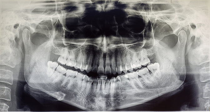 Orthopantomography of an adult patient, dentistry
