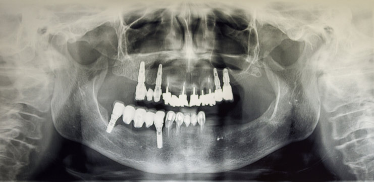 Orthopantomography of an adult patient, dentistry