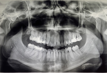 Orthopantomography of an adult patient, dentistry