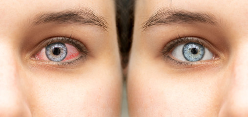 A before and after view of a beautiful caucasian girl who was suffering from red eye...