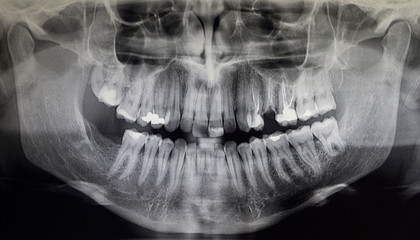 Orthopantomography of an adult patient, dentistry