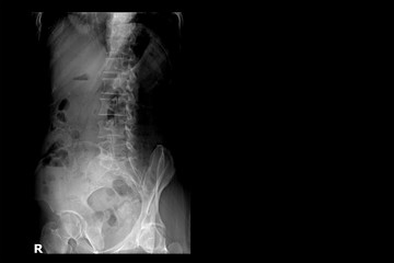X-ray image of lumbar spine (right side).Lumbar Degenerative Spinal Canal Stenosis or Herniated...