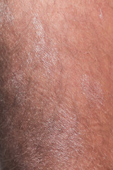 Large plaque parapsoriasis on caucasian man legs