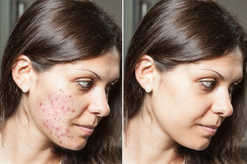 A young woman with brunette hair shows the before and after results of successful acne treatment,...