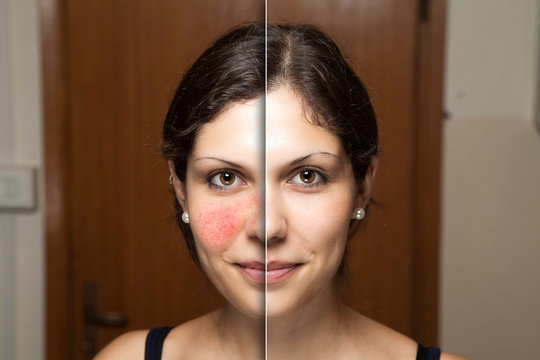 A confident young woman is seen showing the before and after results of successful treatment for rosacea, the red and blotchy cheeks have been removed through laser surgery.