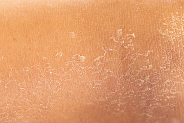 A closeup and macro view in the dry, flaky skin of a caucasian person, filling the frame with...