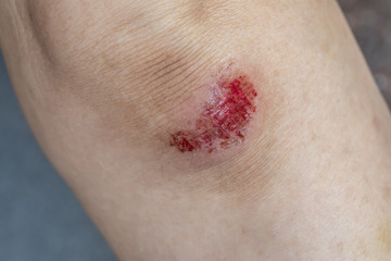 Close-up of a fresh flesh wound on the knee of woman.