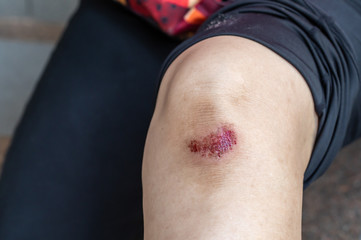 Fototapeta premium Close-up of a fresh flesh wound on the knee of woman.