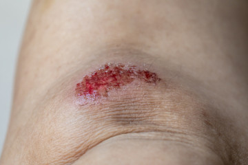 Close-up of a fresh flesh wound on the knee of woman.