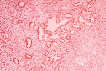 Section tissue of breast cancer view in microscopy.Ductal cell carcinoma.