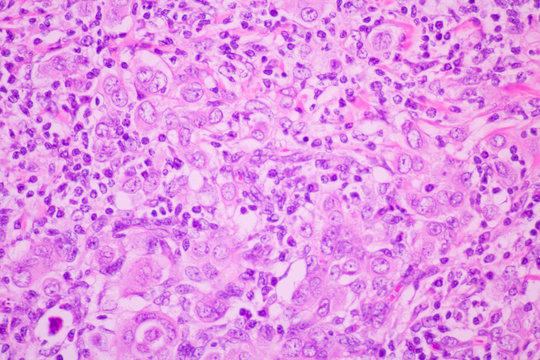 Section tissue of breast cancer view in microscopy.Ductal cell carcinoma.