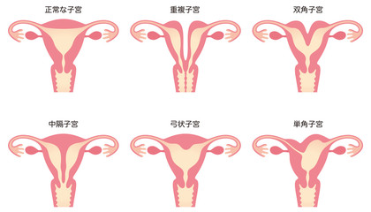 子宮奇形