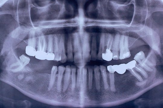 Orthopantomography of an adult patient , panoramic x-ray. dental crown