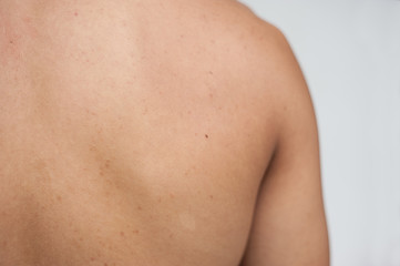 Acne skin. Acne skin on the back. Human skin.