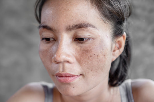 closeup Asian woman face having skin problem with dark spot, freckle from uv ligh