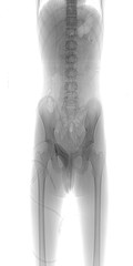 Negative Human body x ray image showing abdomen,pelvis, lumbosacral spine, and femur