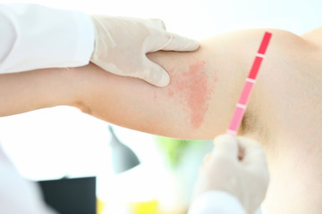 Focus on hardworking male hands in special medical gloves with spectrum inspecting painful sore on body of suffering patient. Professional dermatology clinic advertisement concept. Blurred background