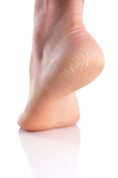 The heel of foot with bad skin is covered with cracks. The concept using medical treatment with moisturizers and also vedekure and peeling of wound healing and pain while walking swatch dermatologist